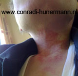 Cindy ligt op bed met het beademingsmasker op haar gezicht.